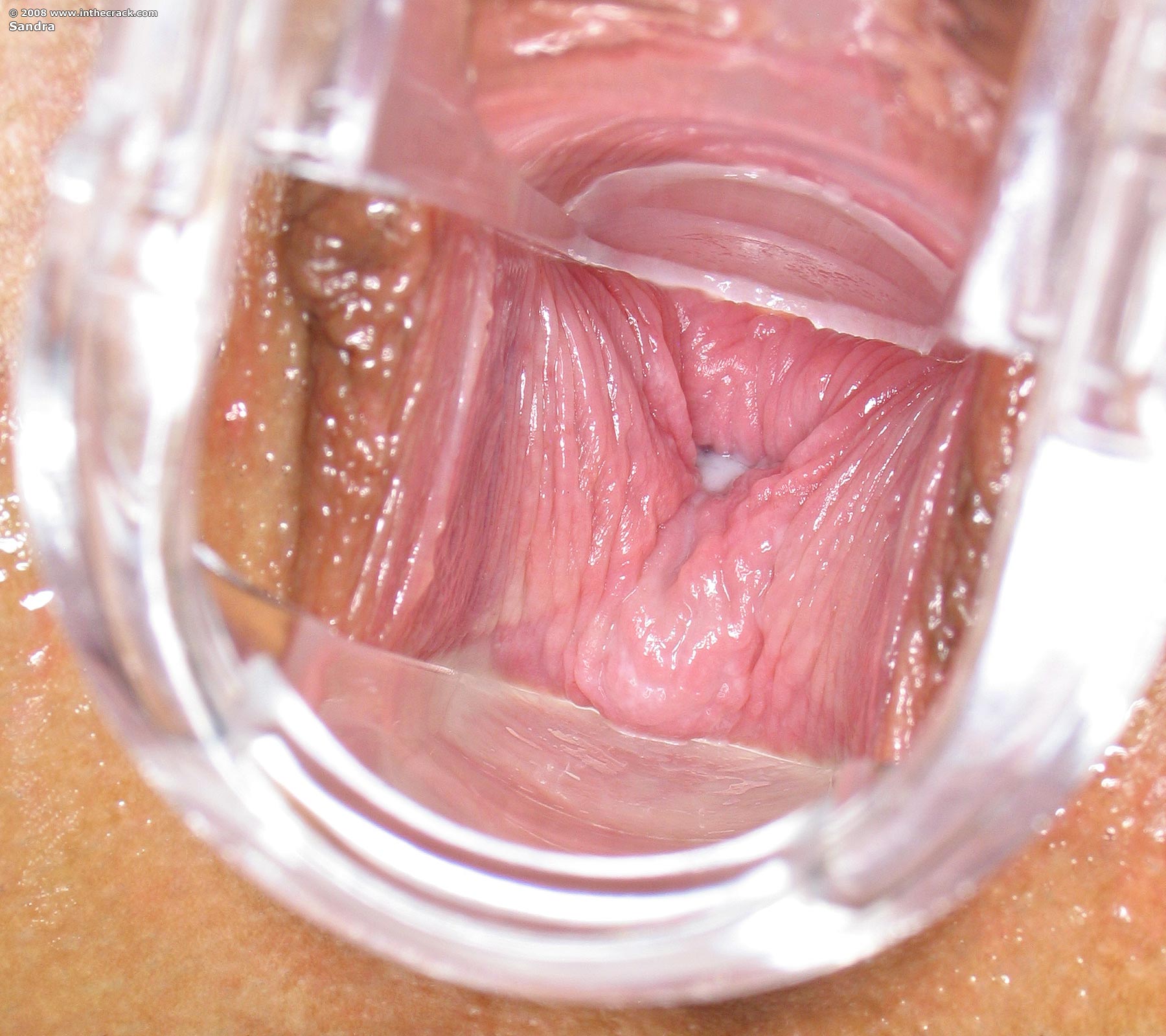 Broken Glass Vagina Pics.